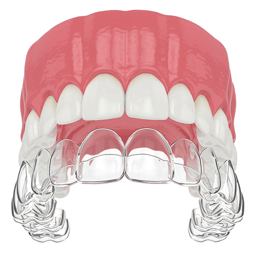 Clear retainer graphic