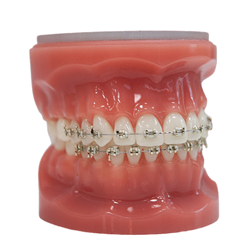 iDENTical Half Metal and Half Ceramic Brackets Orthodontics Model